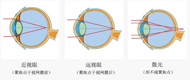 如何判断眼睛是否散光