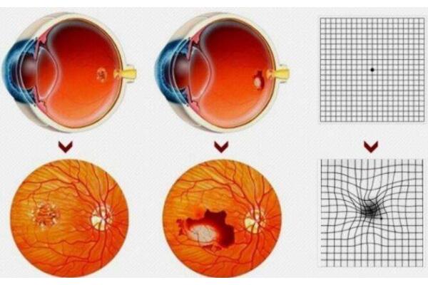 眼睛里面有黄斑是怎么回事
