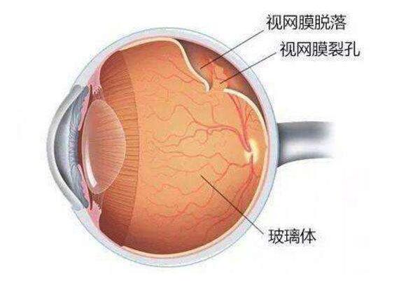视网膜脱离是什么病?90%的人都弄不明白
