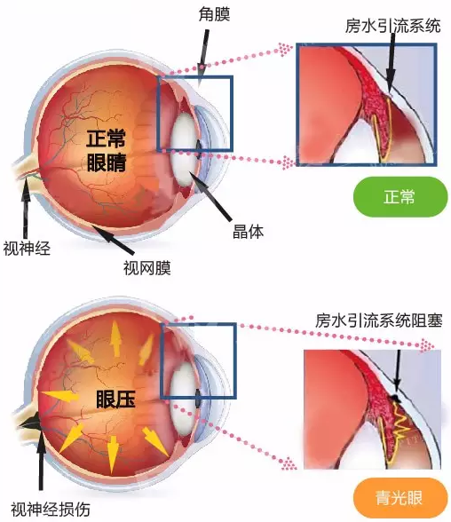 青光眼能治好吗