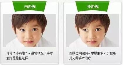 斜视如何治疗好